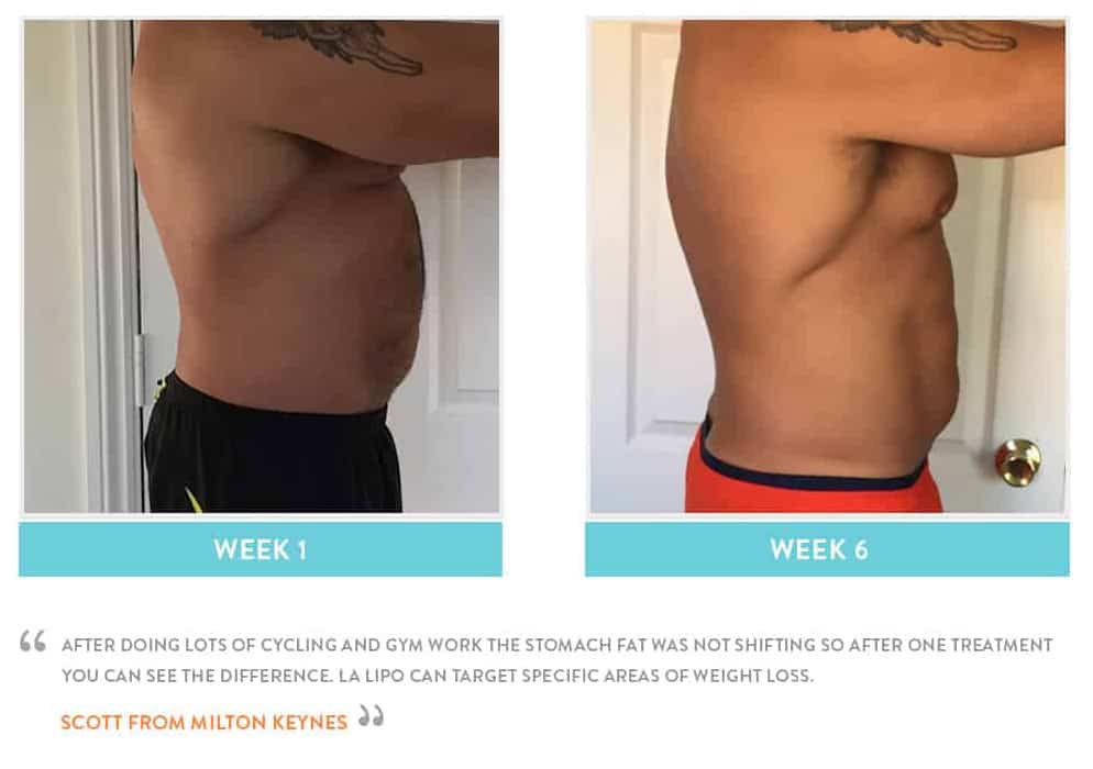 Before & After Stomach Fat Blackpool