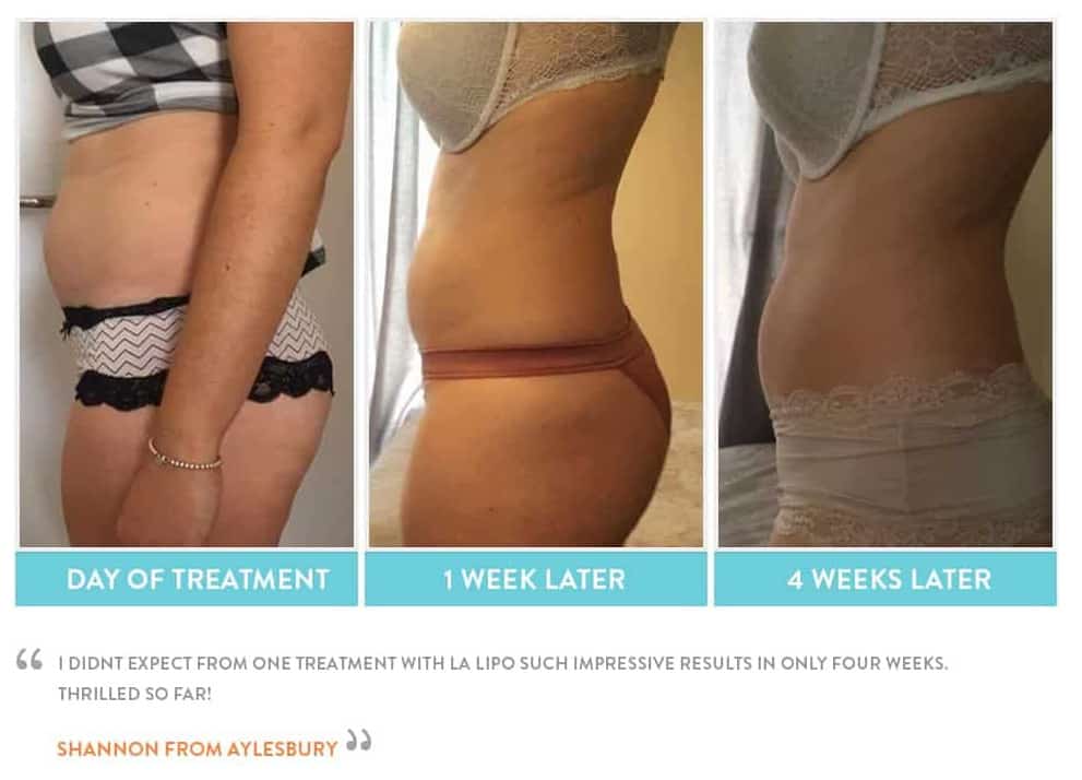 before, Cryolipolysis Blackpool