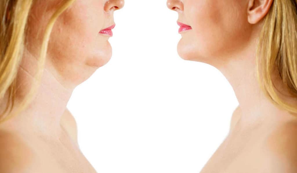 Double Chin treatment Blackpool before and after results