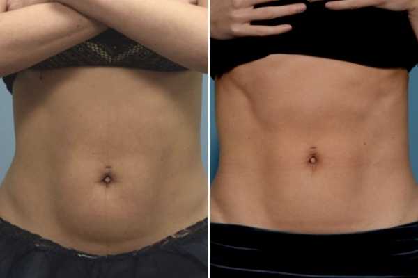body sculpting FAQs Blackpool