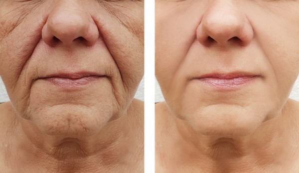 Learn more about Morpheus8 Treatment Blackpool today!