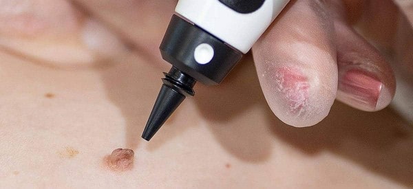 After Skin Tag Removal Blackpool