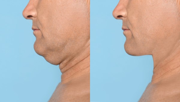 Which Non-Surgical Treatments Work Best for Jowls and Loose Skin Blackpool?