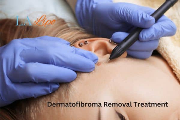 Dermatofibroma Removal Treatment Blackpool