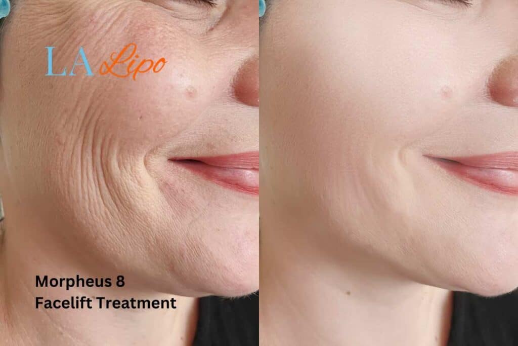 Morpheus8 Treatment Blackpool for flawless skin! Call us today!
