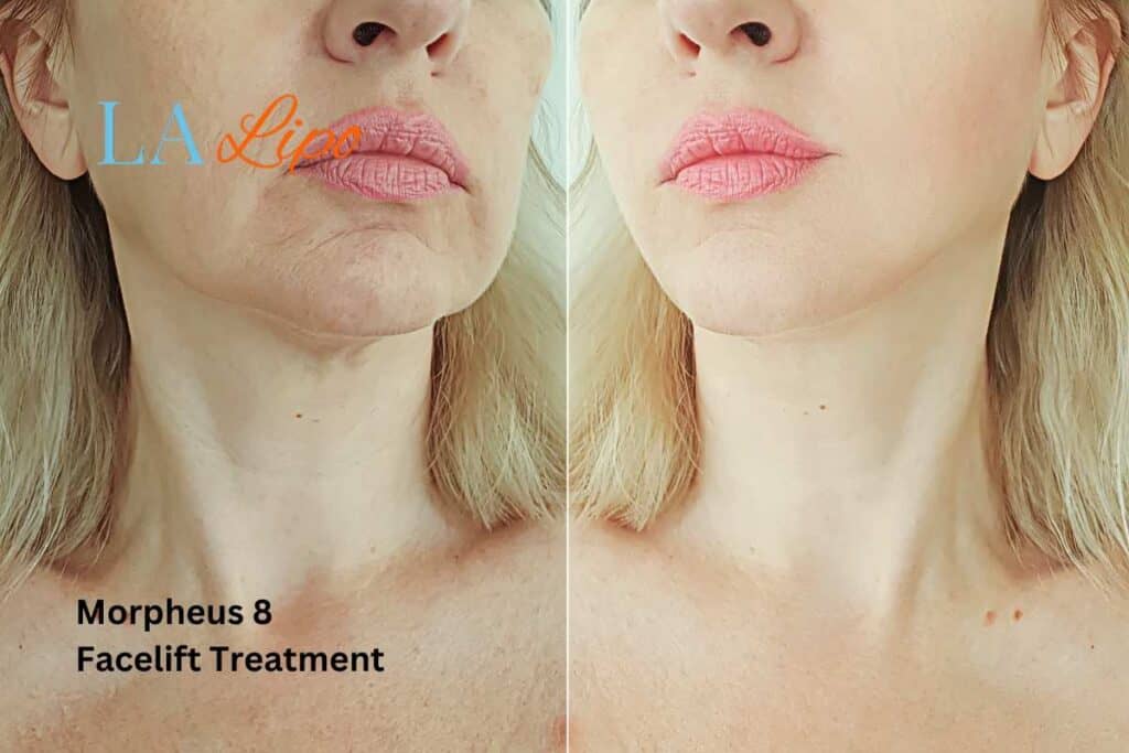 Turn back time with Morpheus8 Treatment Blackpool