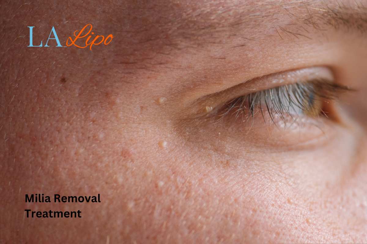 Cryopen Milia Removal: Is It the Easiest and Safest Option Blackpool?