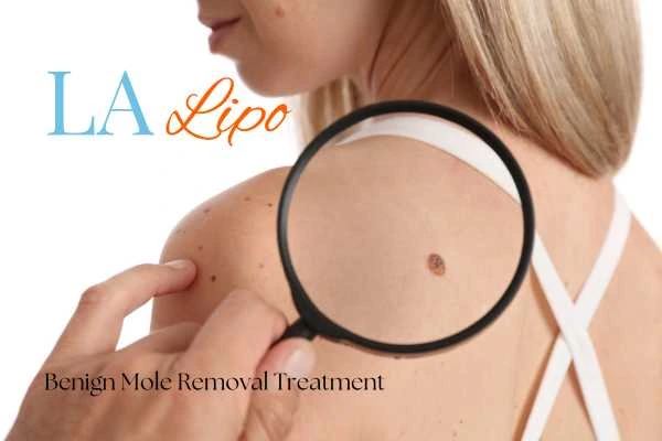 Woman having her inspection of blemish before mole removal Blackpool