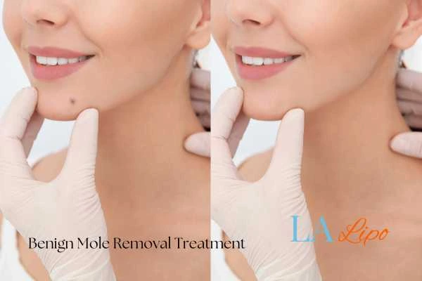 woman's before and after mole removal Blackpool results