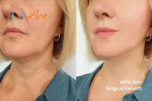 hi-fu for wrinkles Blackpool before and after results