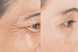 Before and after results of woman - HI-fu wrinkles reduction treatment Blackpool