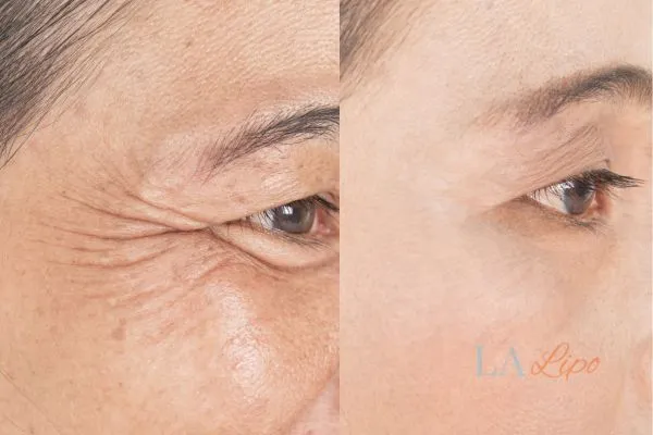 Before and after results of woman - HI-fu wrinkles reduction treatment Blackpool