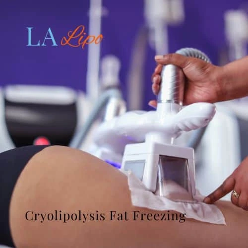 fat freezing - Cryolipolysis Blackpool