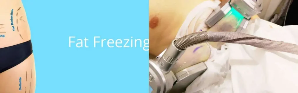 multi areas of a persons body having coolsculpting Blackpool treatment