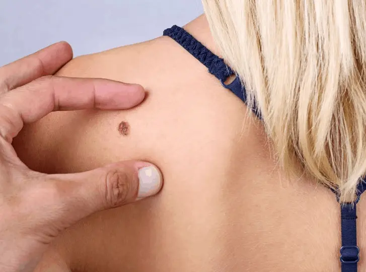 woman having mole removal Blackpool consultation before treatment.