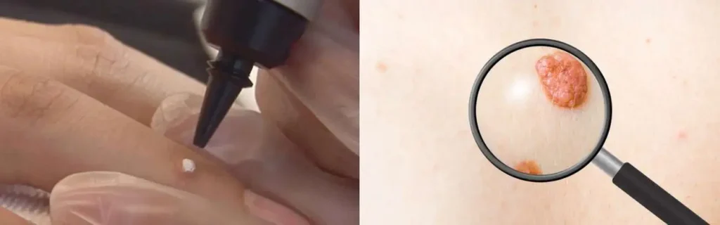 Cryopen for mole removal Blackpool - speak to our team today!