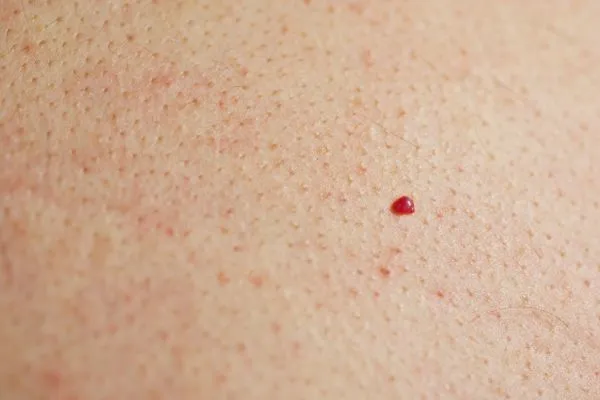 close up of a cherry angioma Blackpool