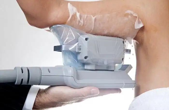Picture of fat freezing Blackpool on the upper arms.