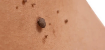 image of a skin tag Blackpool