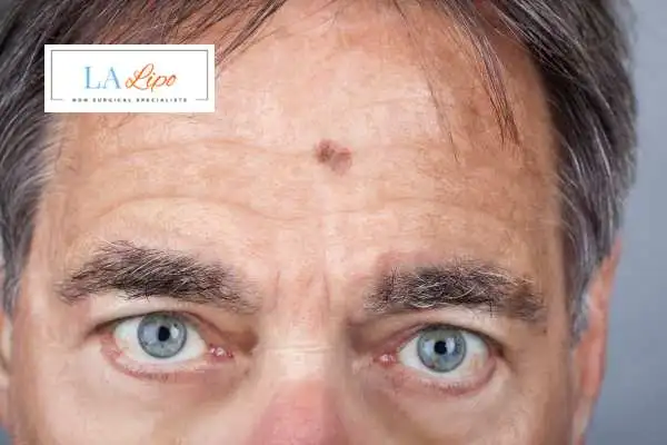 Solar Lentigo Removal Blackpool image of man with mark on his forehead