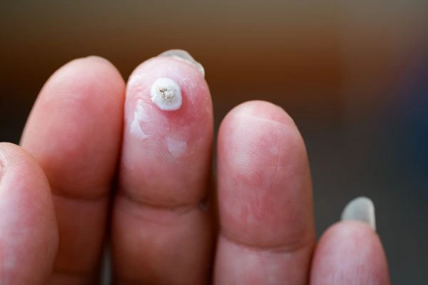 wart on person finger - cryotherapy to treat from LA LIPO Blackpool