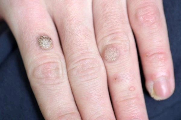 photo of warts on person hand - see wart removal Blackpool from LA LIPO