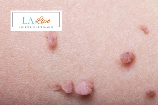 Does cryopen skin tag removal Blackpool hurt? Find out now call our team today!