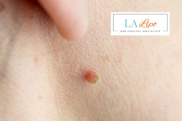 Book skin tag removal Blackpool today speak to our team now!