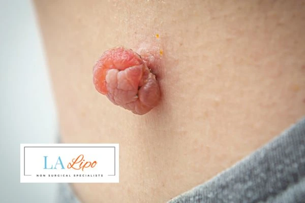 Interested in skin tag removal Blackpool? Concerned about the pain? Find out more today!