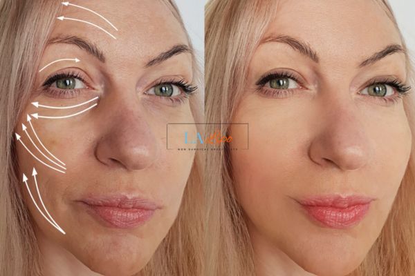 Morpheus 8 results Blackpool face lift.