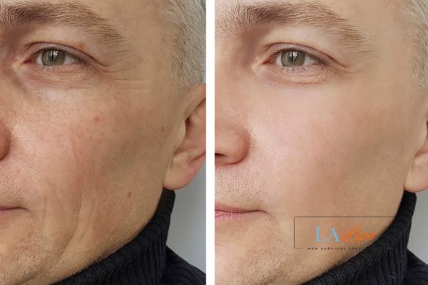 See the amazing results of Morpheus8 Treatment Blackpool!