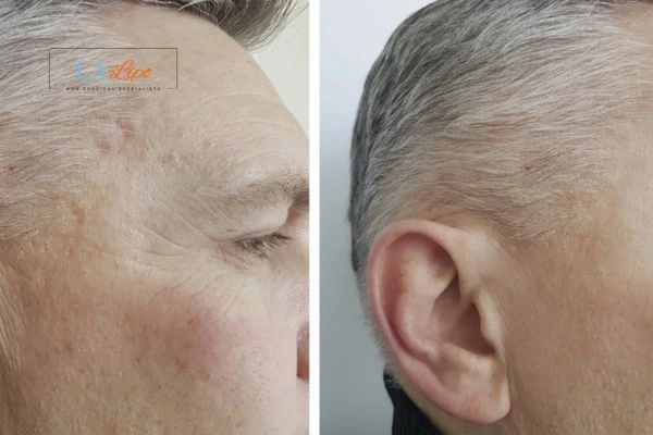 Mens Before & After Morpheus 8 Results Blackpool