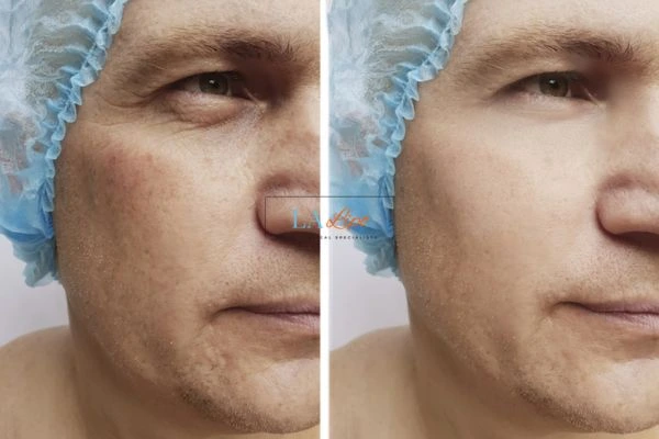 Before and after Morpheus 8 Results Blackpool