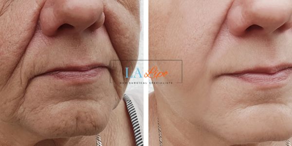 Older lady deeper wrinkle reduction - LA LIPO Morpheus 8 Results Blackpool