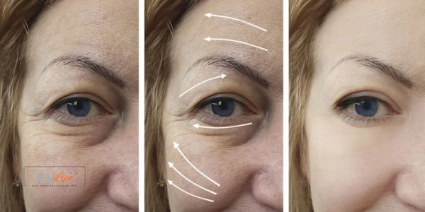 Amazing eye lift Morpheus 8 results Blackpool