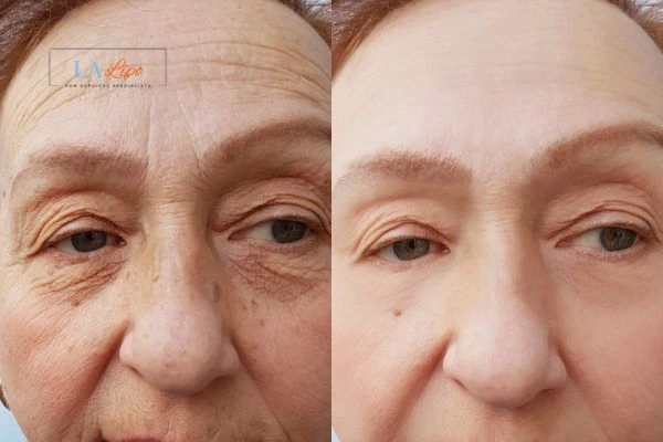 The powerful benefits of Morpheus8 Treatment Blackpool - Call Our team today!