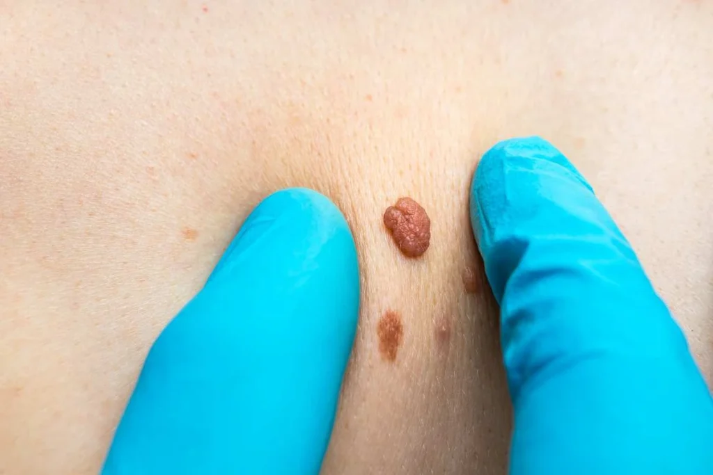 LA LIPO Cryopen Lesion Removal Prices Blackpool