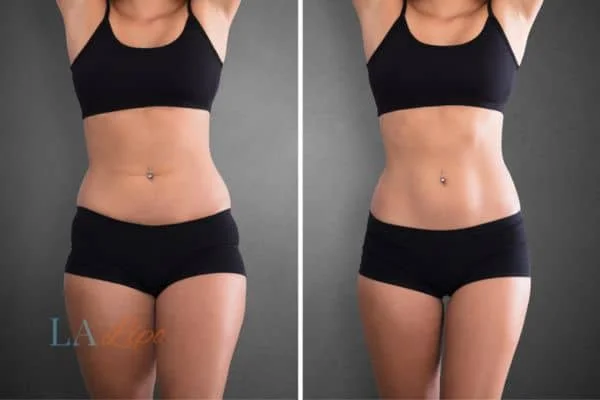 before and after results of non-surgical treatment to help a woman's body image and mental health Blackpool