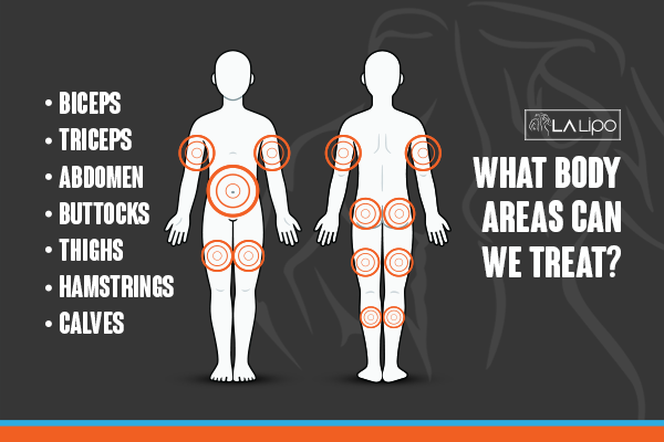 Diagram to show areas you can have LA-EMS Body Sculpting Treatment Blackpool