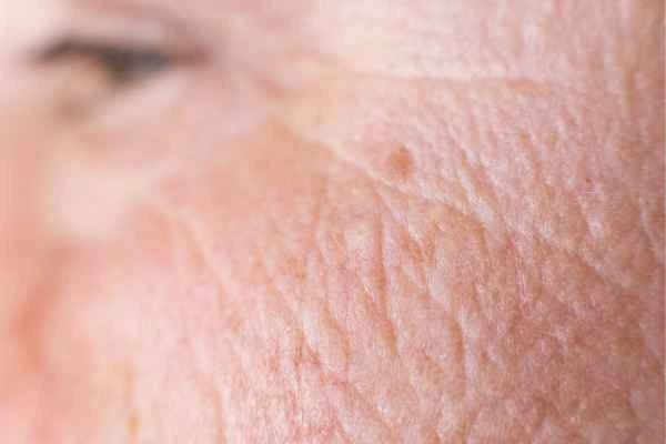 close up picture of a woman's face showing an age spot Blackpool