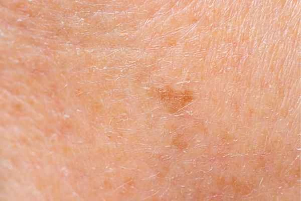 close up picture of age spots Blackpool