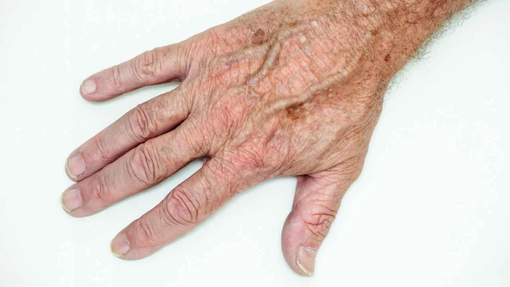 Male hand showing age spot Blackpool