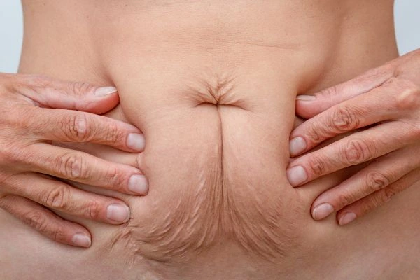 Should I Combine Diastasis Recti Treatment with Body Contouring for Better Results Blackpool?