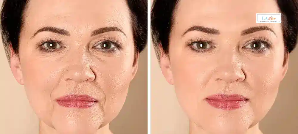 How Long Does It Take to See Results and How Long Do They Last Blackpool?