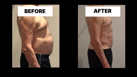 What Symptoms Can Diastasis Recti Cause in Men? Weak Core, Back Pain and Poor Posture Blackpool
